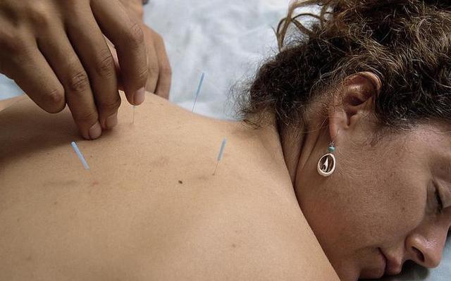 Sesión de acupuntura en la espalda